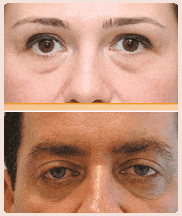 Gentian Anti-Wrinkle Eye Cream and Dark Circles Gomuto